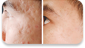 Antes y después LUXYA PRO - rostro